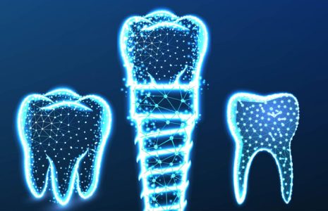 Dental implant illustration showing artificial tooth structure and replacement teeth