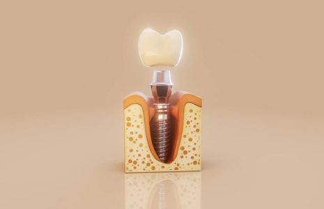 Dental implant cross-section showing implant screw and jawbone structure in 3D model
